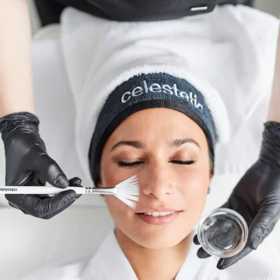 fruitzuur-peeling-behandeling Vrouw die een fruitzuut peeling behandeling krijgt op haar gezicht