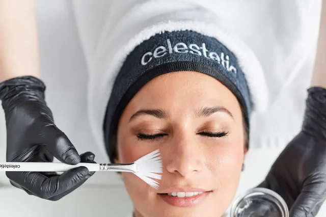 fruitzuur-peeling-behandeling Vrouw die een fruitzuut peeling behandeling krijgt op haar gezicht