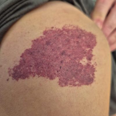 Litteken camouflage therapie Litteken voor behandeling camouflage therapie