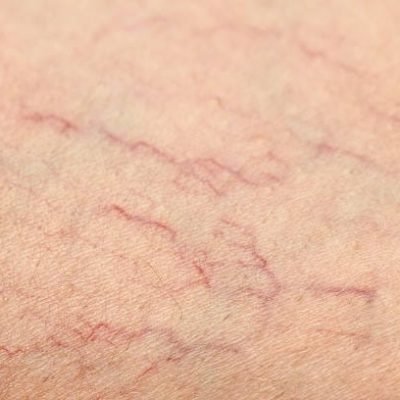 Spin ader Human Spider Veins on Leg Closeup
