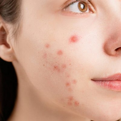 pexels-photo-6475987-6475987 A detailed close-up of a woman's face showing acne blemishes on her skin.
