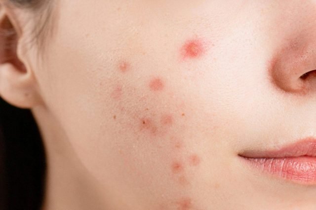 pexels-photo-6475987-6475987 A detailed close-up of a woman's face showing acne blemishes on her skin.